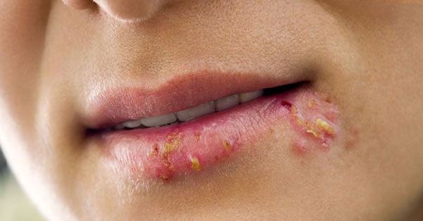 HSV2 herpes boca HSV2_herpes-boca